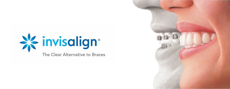 Invisalign la nueva tecnología de ortodoncia invisible