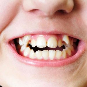 tipos de maloclusion