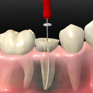 endodoncia