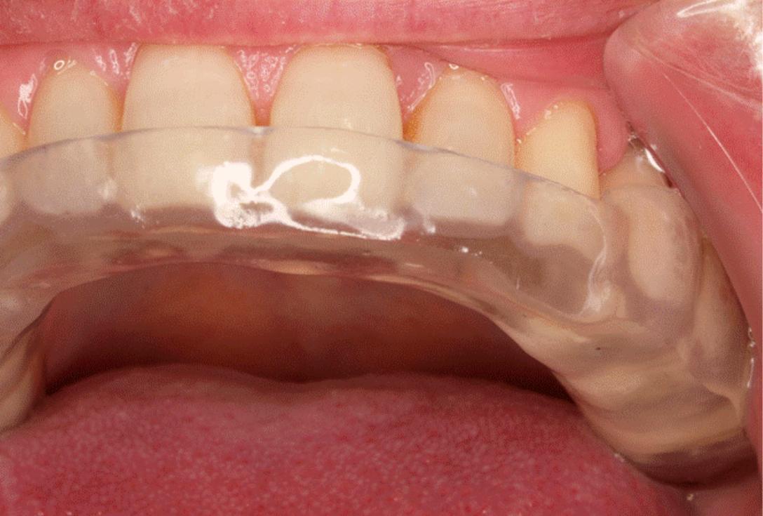 Férula de descarga para tratar bruxismo y TMD: todo lo que necesita saber -  Clínica Dental Rocamora