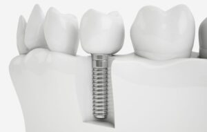 cirugía implantes dentales