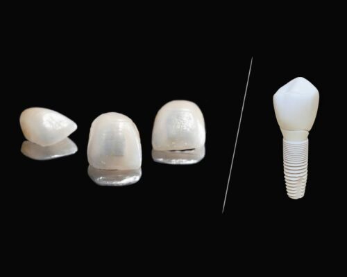 ¿En qué se diferencian las carillas dentales de los implantes dentales?