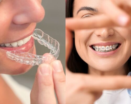 Transforma tu sonrisa con ortodoncia: Tipos de tratamientos y cuál elegir