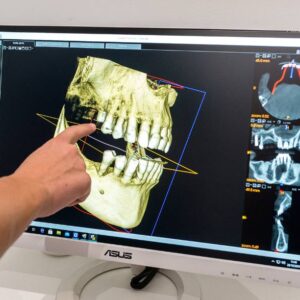 implantes dentales edad minima y maxima