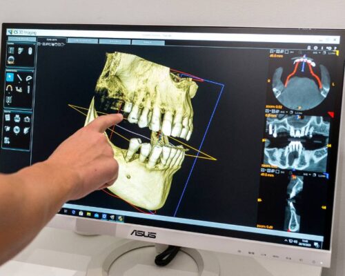 ¿Existe una edad mínima o máxima para poder colocar implantes dentales?