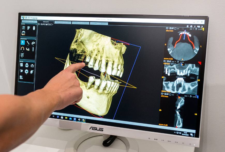 implantes dentales edad minima y maxima