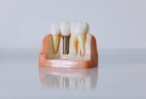 implantes dentales edad minima y maxima