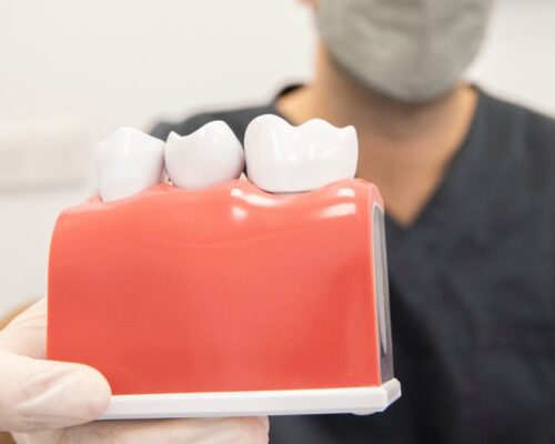 ¿Qué es una prótesis dental?